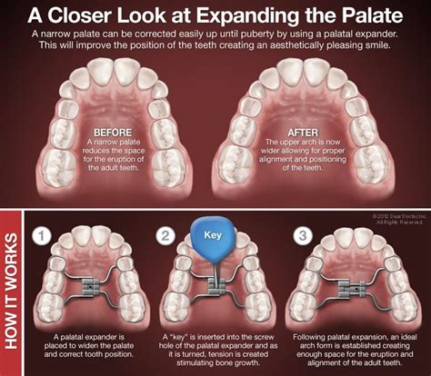 Pin on DENTAL HEALTH & ORTHODONTICS