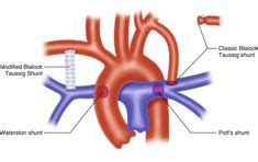 23 B-T Shunt ideas | pulmonary, stenosis, arteries