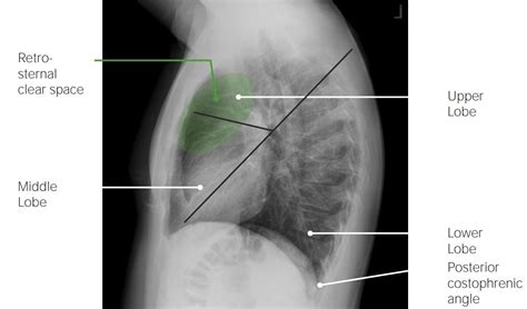 Normal Chest X-ray: Anatomy Tutorial Kenhub, 43% OFF