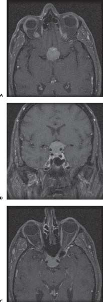 22 Tuberculum Sellae Meningiomas | Neupsy Key