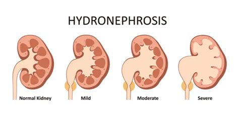 Hydronephrosis: Causes, Symptoms, Diagnosis, Treatment, & More - Healthroid