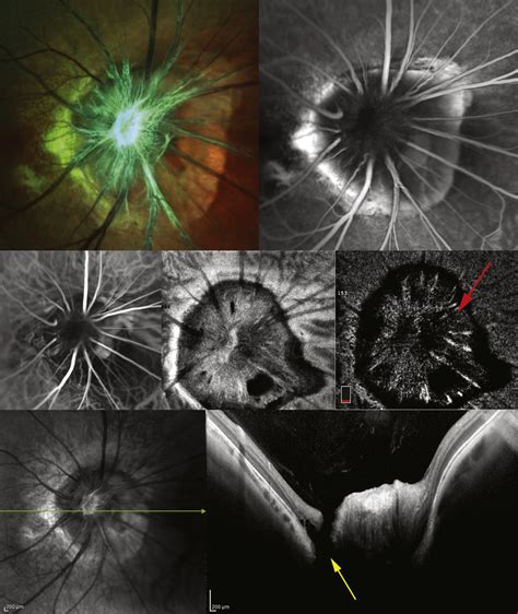 Morning glory syndrome in the right eye of an 18-year-old woman. (Top... | Download Scientific ...