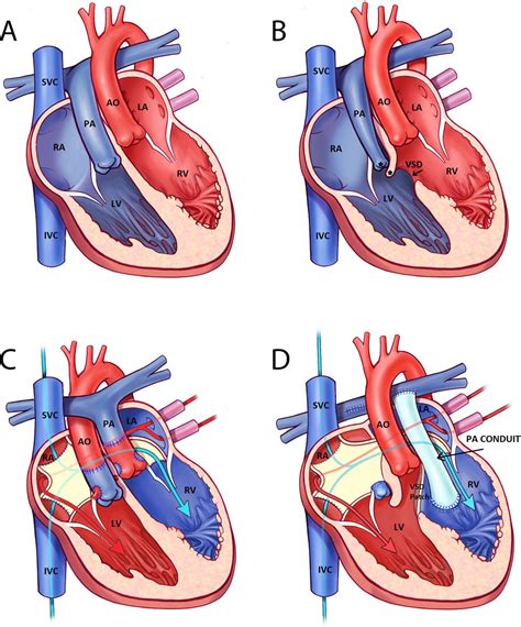 Contemporary management and outcomes in congenitally corrected transposition of the great ...