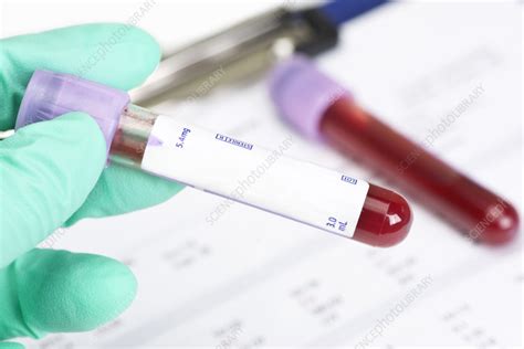 Blood sample collection - Stock Image - F035/8879 - Science Photo Library