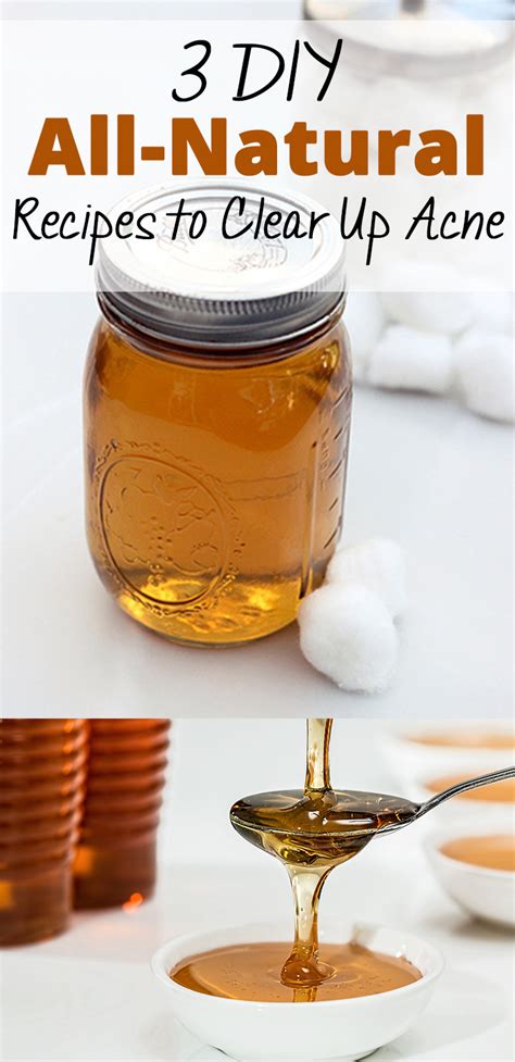 3 DIY All- Natural Recipes to Clear Up Acne