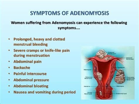 Adenomyosis - The Symptoms & Best Treatment Options