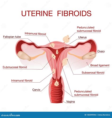 Vulvovaginal Candidiasis or Vaginal Yeast Infection.Vector Illustration ...