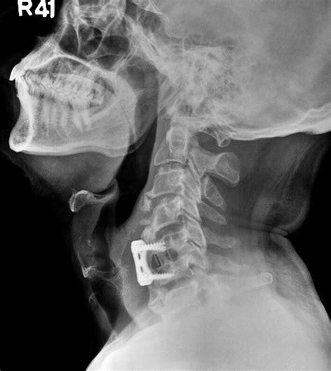 Dysphagia due to DISH-related anterior osteophytes: DISHphagia!! | BMJ Case Reports