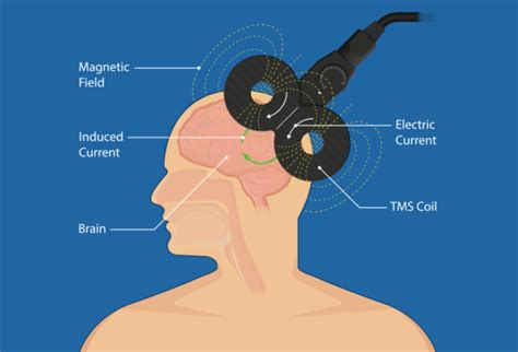 The Basics of Transcranial Magnetic Stimulation | Sapien Labs | Neuroscience | Human Brain ...