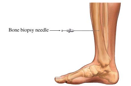 Osteomyelitis