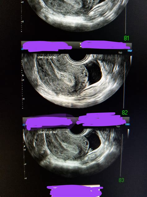 Ultrasound results- details in comments : r/DiagnoseMe