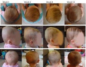 My Twins and Their Plagiocephaly Helmet Story (With images ...