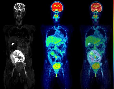 PET/MRI appears safe for pregnant women