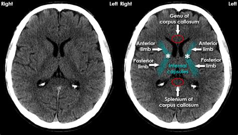 CT Brain Anatomy - White matter structures