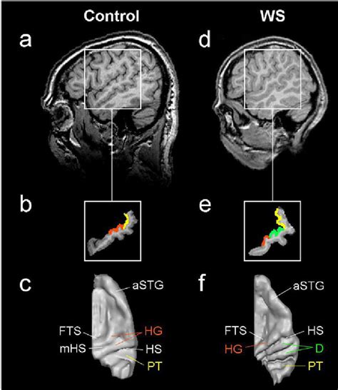 Anatomical landmarks of the auditory cortex. Auditory cortex (AC) of... | Download Scientific ...