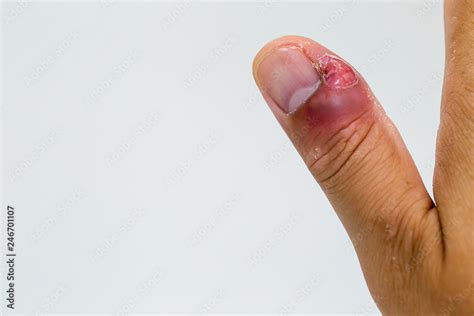 Paronychia, swollen finger with fingernail bed inflammation due to bacterial infection on a ...