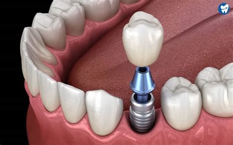 Titanium Vs. Zirconia Tooth Implants: Cost, properties, pros & cons