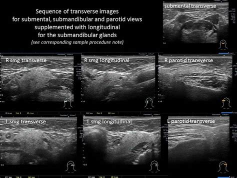 Salivary ultrasound standardized diagnostic approach and report | Iowa Head and Neck Protocols