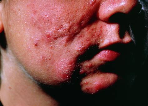 Severe Acne Scarring Over An Adolescent Boy's Face Photograph by Eamonn ...