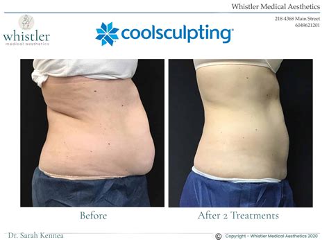 Does Coolsculpting work? | Whistler Medical Aesthetics