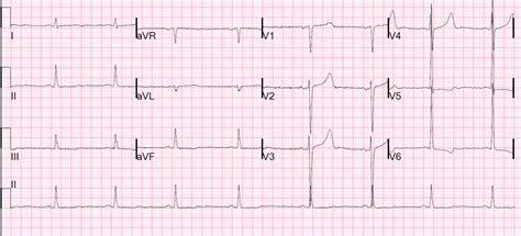 Dr. Smith's ECG Blog: Bradycardia, SOB, in a Dialysis Patient