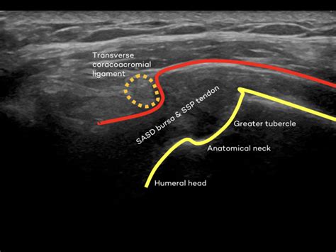 Supraspinatus full thickness tear | Ultrasound Cases