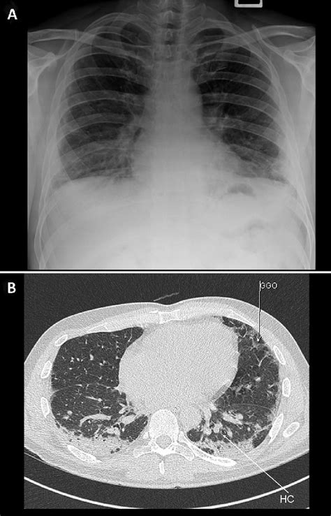 Figure 1 from Acute interstitial pneumonia (Hamman-Rich syndrome) in idiopathic pulmonary ...