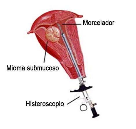 Miomectomía histeroscópica: el último avance para la extirpación de los miomas submucosos ...