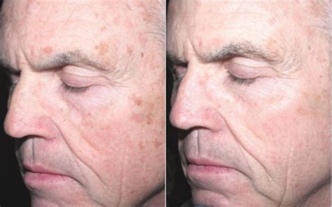 BBL® Laser Skin Rejuvenation Before and After Photo Gallery | Toronto ...