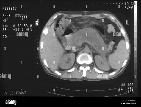 This is a CT scan of a patient with acute pancreatitis Stock Photo - Alamy