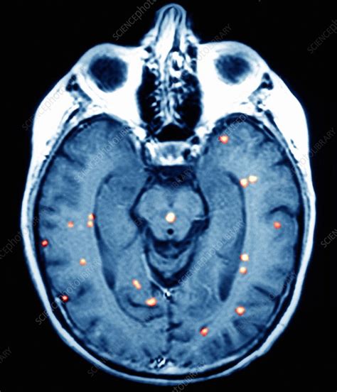 Brain cancers, MRI scan - Stock Image - M134/0472 - Science Photo Library