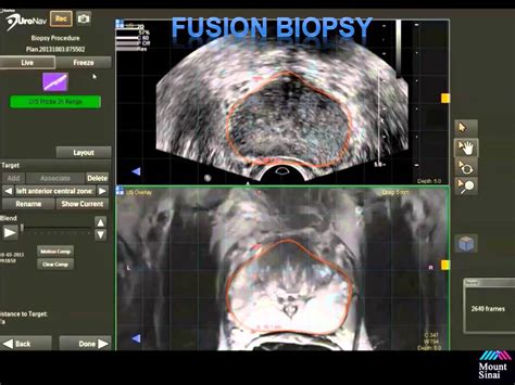 How to perform a prostate fusion guided biopsy: UroNav v 1.1 - YouTube