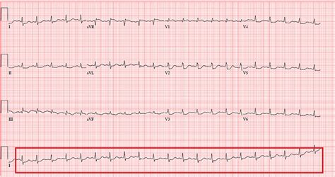 What Do You See in This ECG? | Clinician Reviews