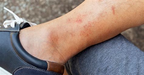 Hives vs. Rash: Identification, Symptoms, Causes, and Treatment