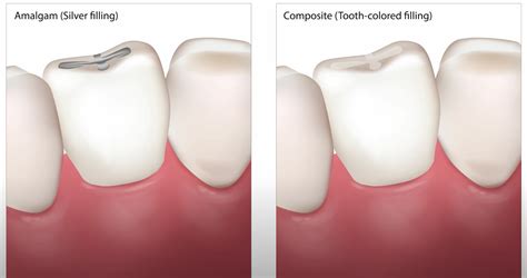 Lost a Filling? Here are a few Immediate Steps and Dental Solutions