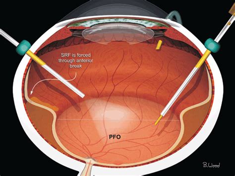 Vitrectomy for Retinal Detachment | Ento Key