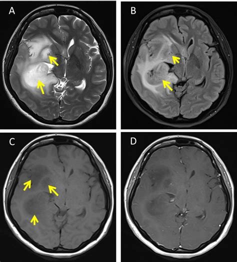 Diffuse astrocytoma – Radiology Cases