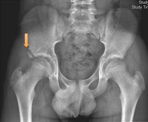 Anteroposterior radiograph of a right hip anterior inferior iliac spine... | Download Scientific ...