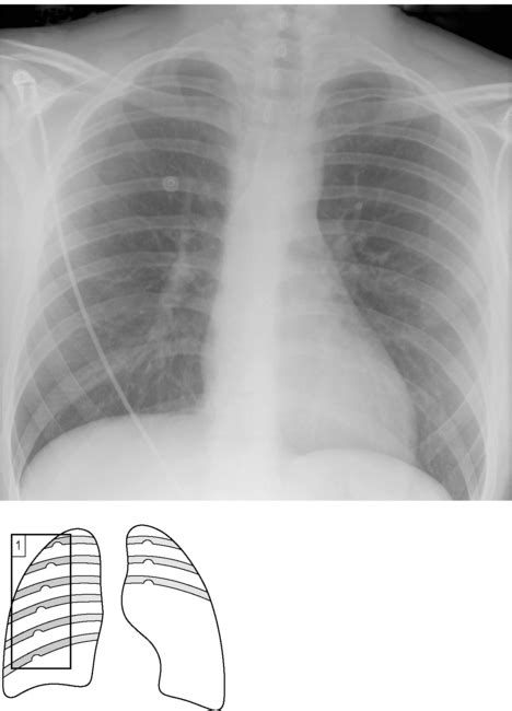 Coarctation of the aorta | Radiology Key