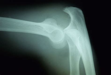 Elbow Dislocation Causes, Symptoms, and Treatment