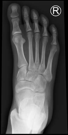 Normal foot x-rays | Radiology Case | Radiopaedia.org