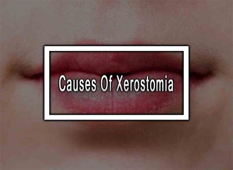 5 Causes Of Xerostomia