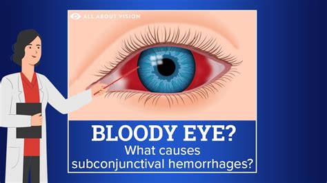 Subconjunctival Hemorrhage (Blood In Eye) Causes Treatment