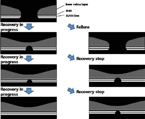 Schematic drawing of the various macular hole healing process after ...