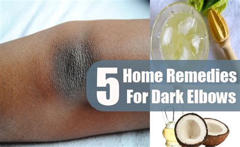 5 Amazing Home Remedies For Dark Elbows - Natural Treatment For Dark Elbows | AyurvedicCure.com