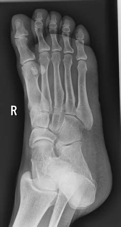 Jones fracture | Radiology Reference Article | Radiopaedia.org