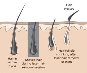 My Experience with Laser Hair Removal (in Boston)