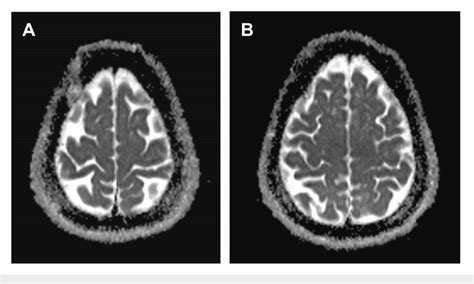 (A and B) MRI showing normal ADC in the cortical regions supplied by... | Download Scientific ...