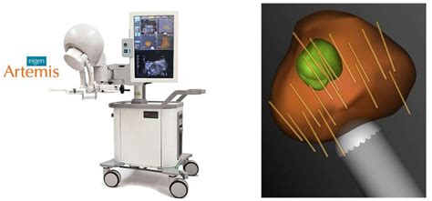 Ultrasound-MRI Fusion for Targeted Diagnosis of Prostate Cancer - CASIT ...