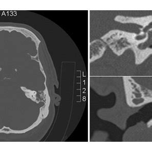 Axial and coronal CT images showing the tegmen defects. | Download Scientific Diagram